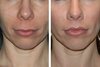 lip-lift-patient-before-and-after-photos-14a.jpg