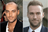 Calum-Best-Hair-Transplant-Before-and-After-300x197.png