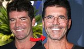 Simon-Cowell-s-teeth-before-and-after-1174742.jpg