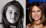 Melania-Trump-Plastic-Surgery-Before-and-After-Photos.jpg