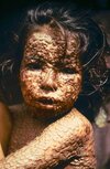 Child-with-Smallpox-Bangladesh-1973.jpg