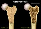 100917Osteoporosis_1.jpg