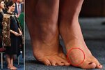 0_MAIN-Meghan-Markle-had-toe-breaking-surgery-to-perfect-her-feet-after-onion-like-bunion-left.jpg